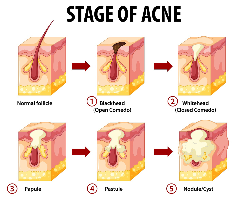 Visual guide of the different stages of acne, from mild to severe