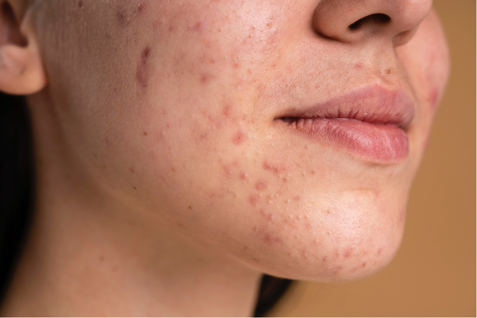 Adult female with visible hormonal acne 