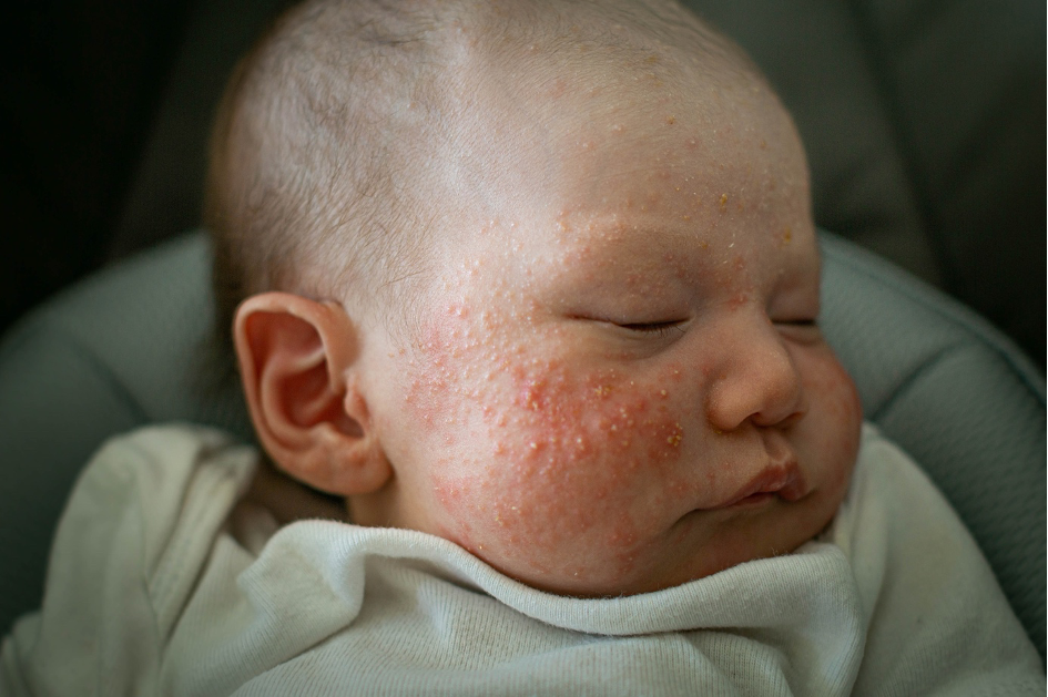 Close-up of infant skin with small red or white bumps (baby acne)
