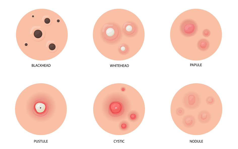 Visual of the different types of acne pimples: whiteheads, blackheads, papules, pustules, nodules, cysts