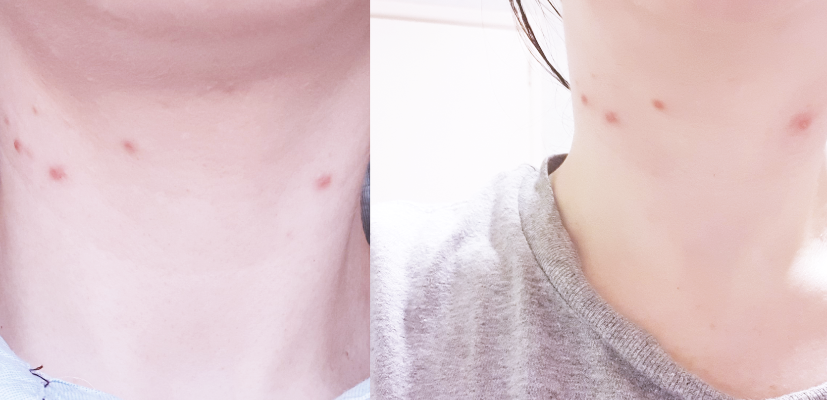 Visible cystic acne breakouts on the neck area, inflamed and under the skin