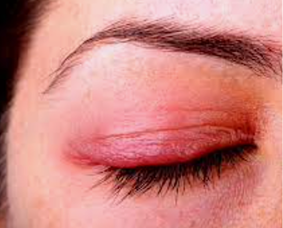 A person with Ocular Rosacea