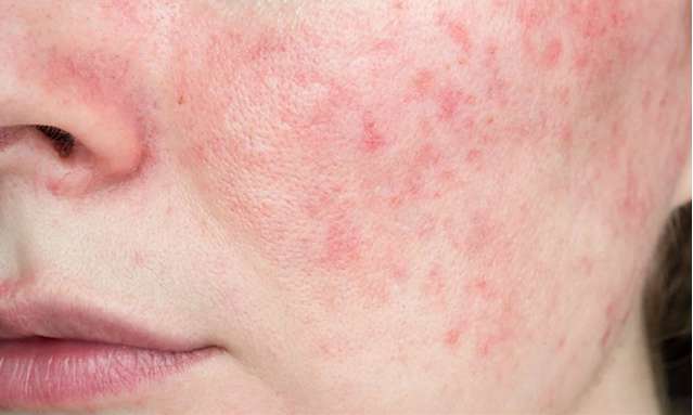 A person with Papulopustular Rosacea