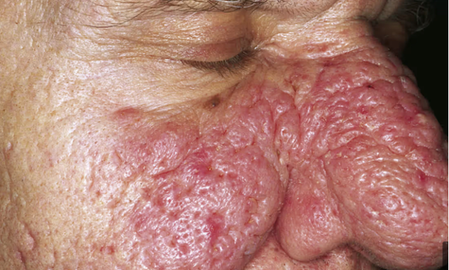 A person with Phymatous Rosacea