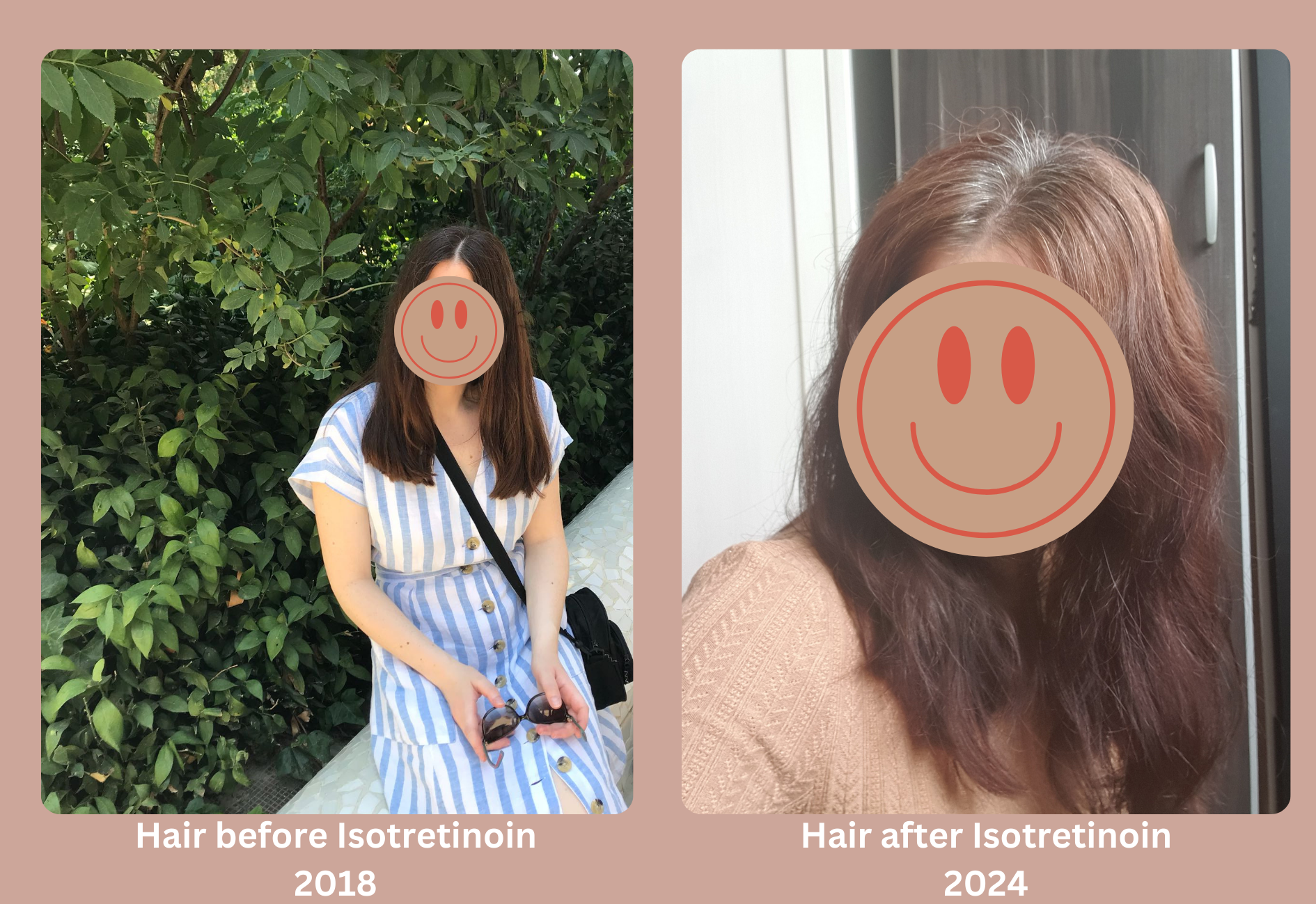 Before and after photos of my hair, 2018 vs. 2024 after Roaccutane treatment