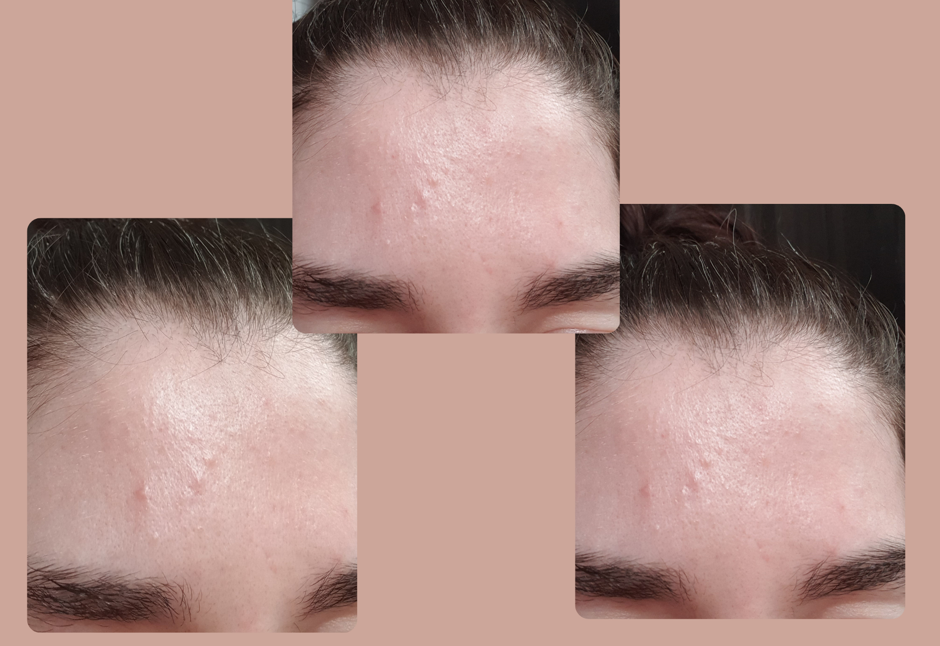 My forehead just after using urea and tretinoin together