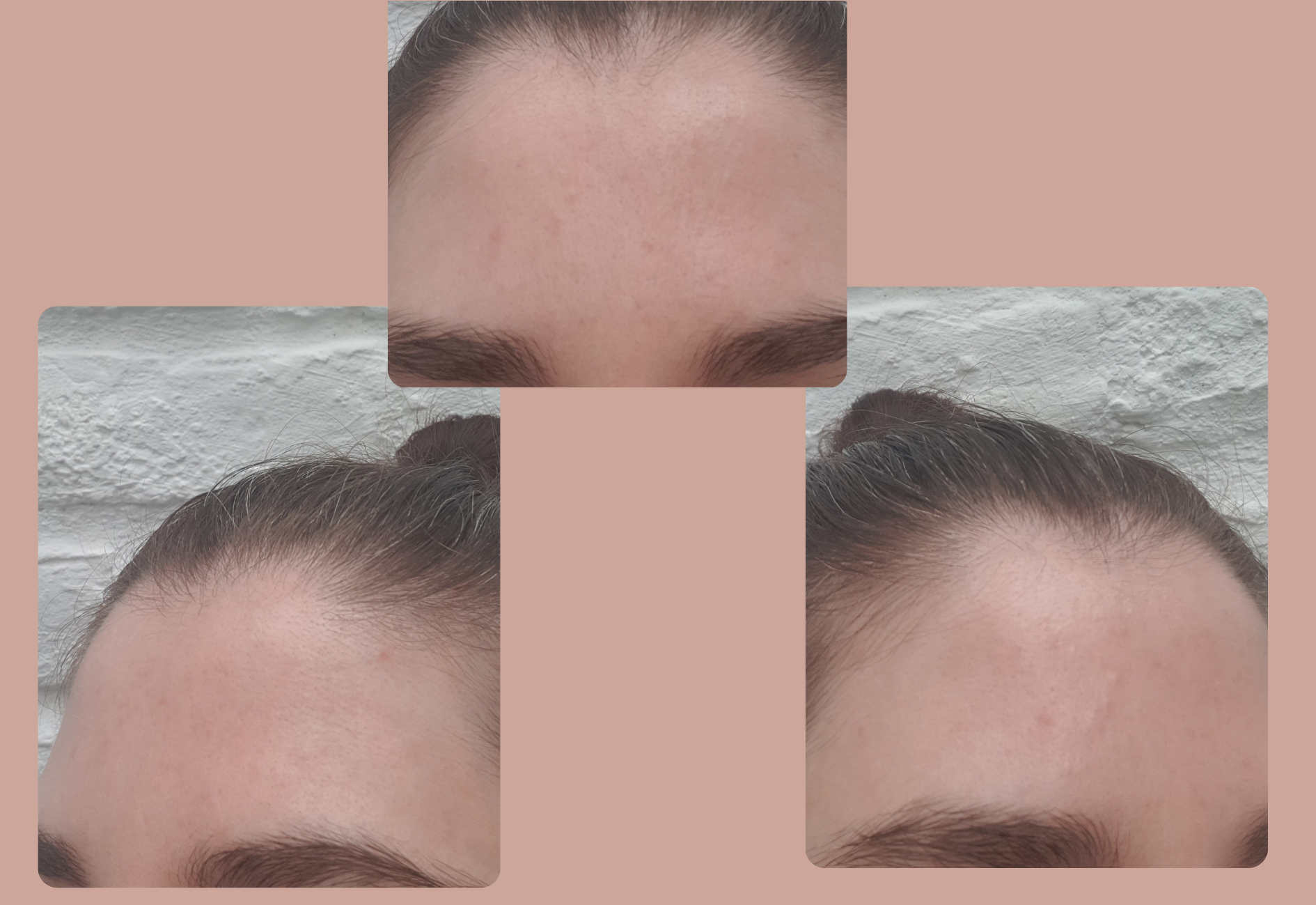 My forehead after using urea and tretinoin together (2 days after I stopped)