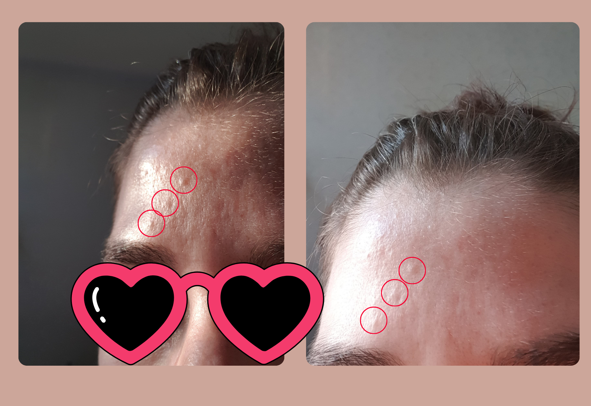 My sebaceous hypoplasia on the forehead