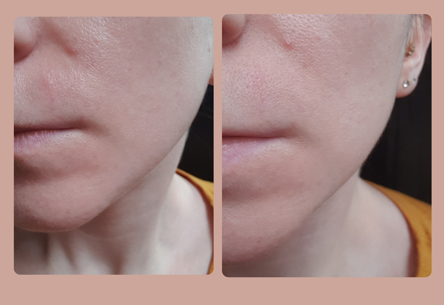 My skin after using urea and tretinoin, with better lighting