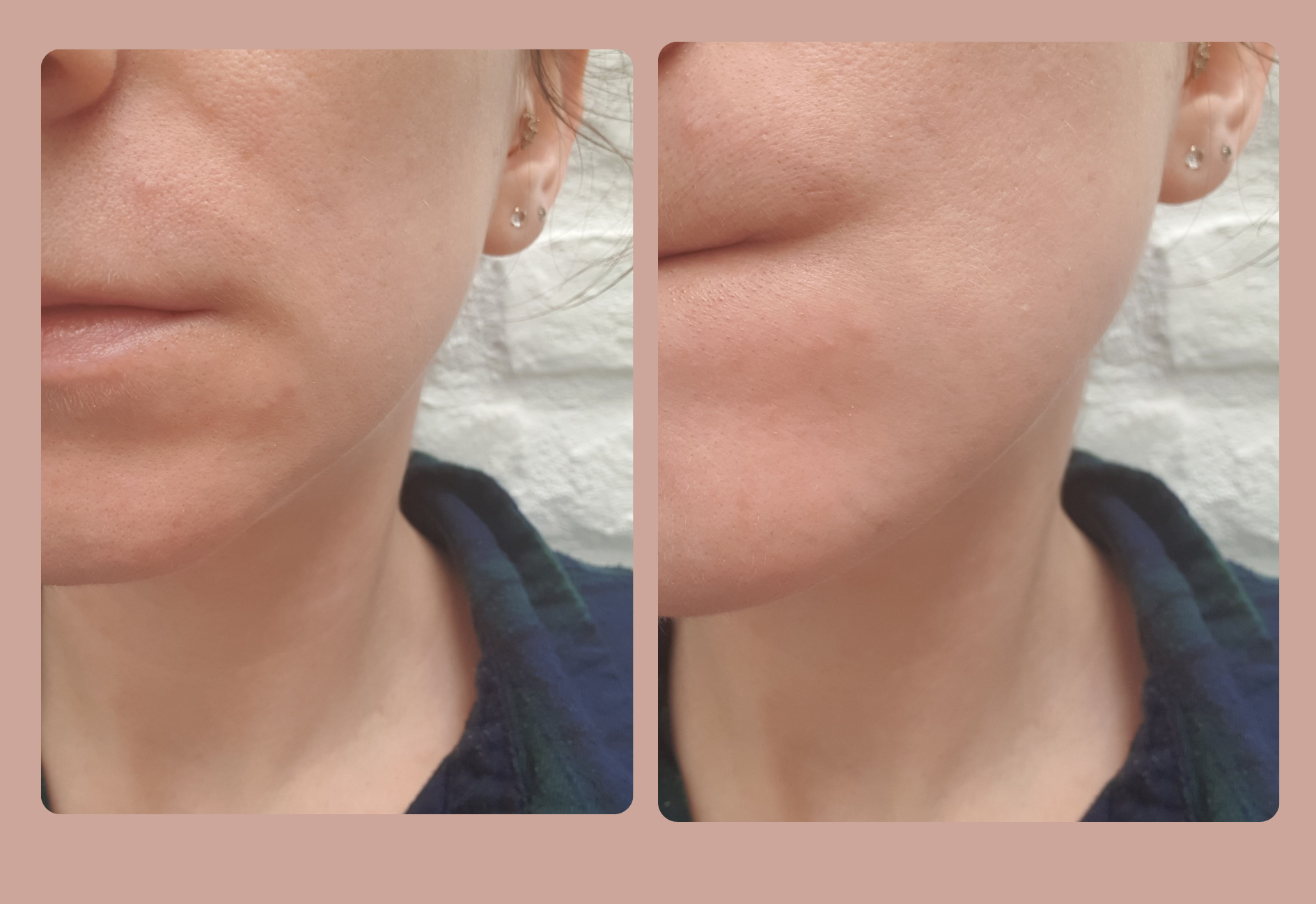 My skin after using urea and tretinoin together