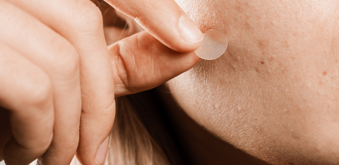 Cover image for my article about anti-acne patches