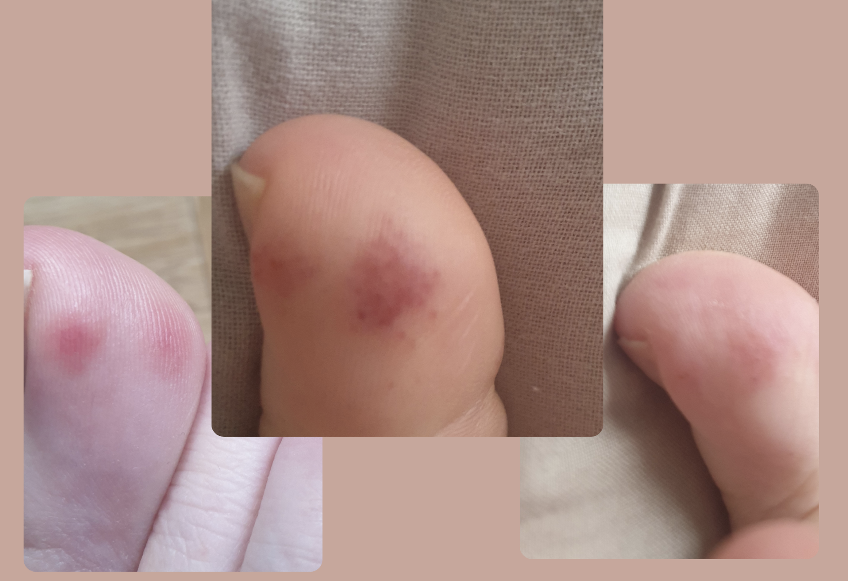 Chilblains on my feet - showing redness and swelling