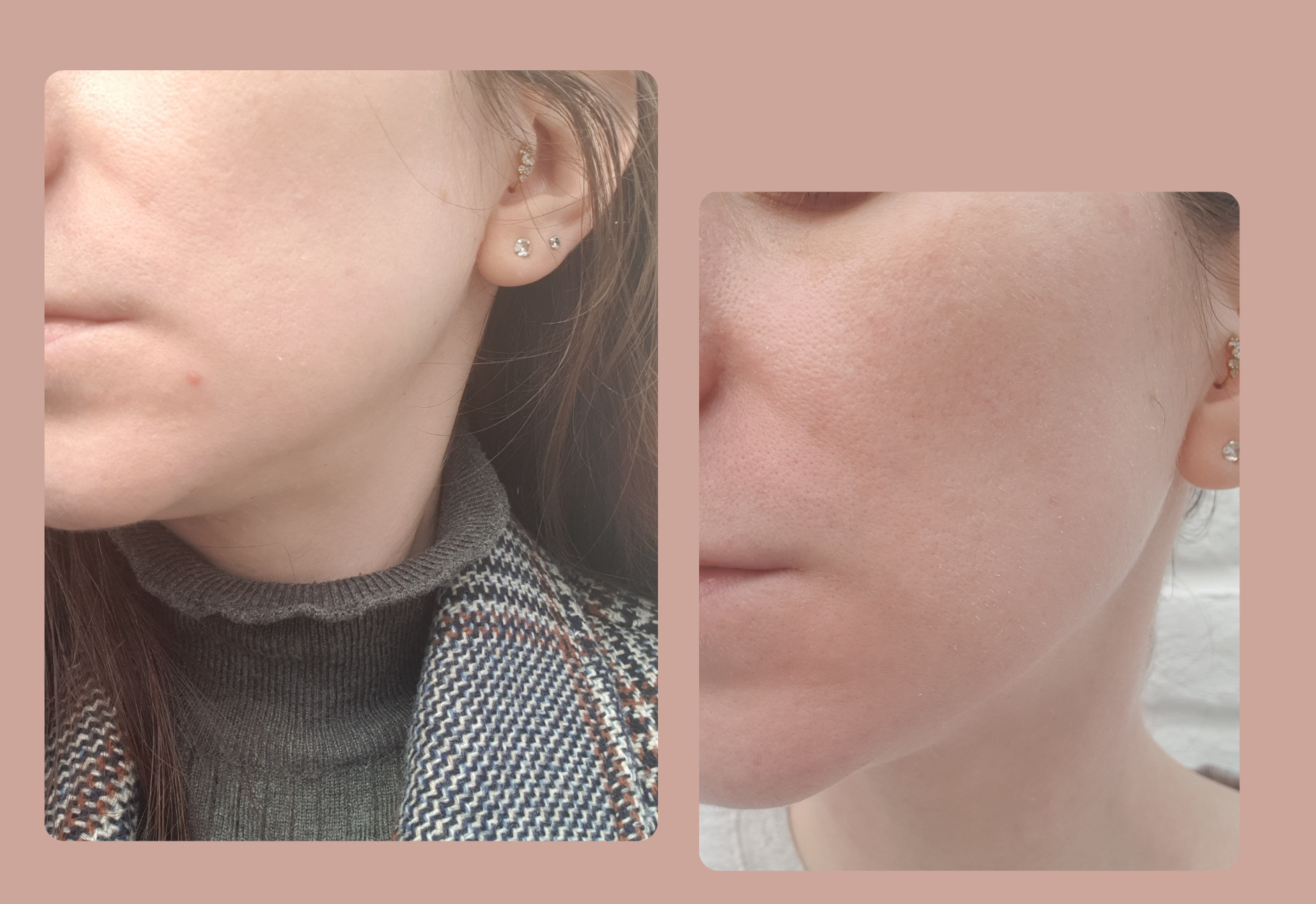 Two photos of my skin's condition showing its glow without Vitamin C