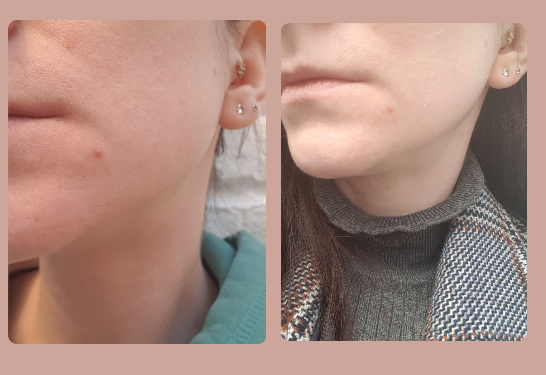 Pimple evolution after one and two days with SOME BY MI patch