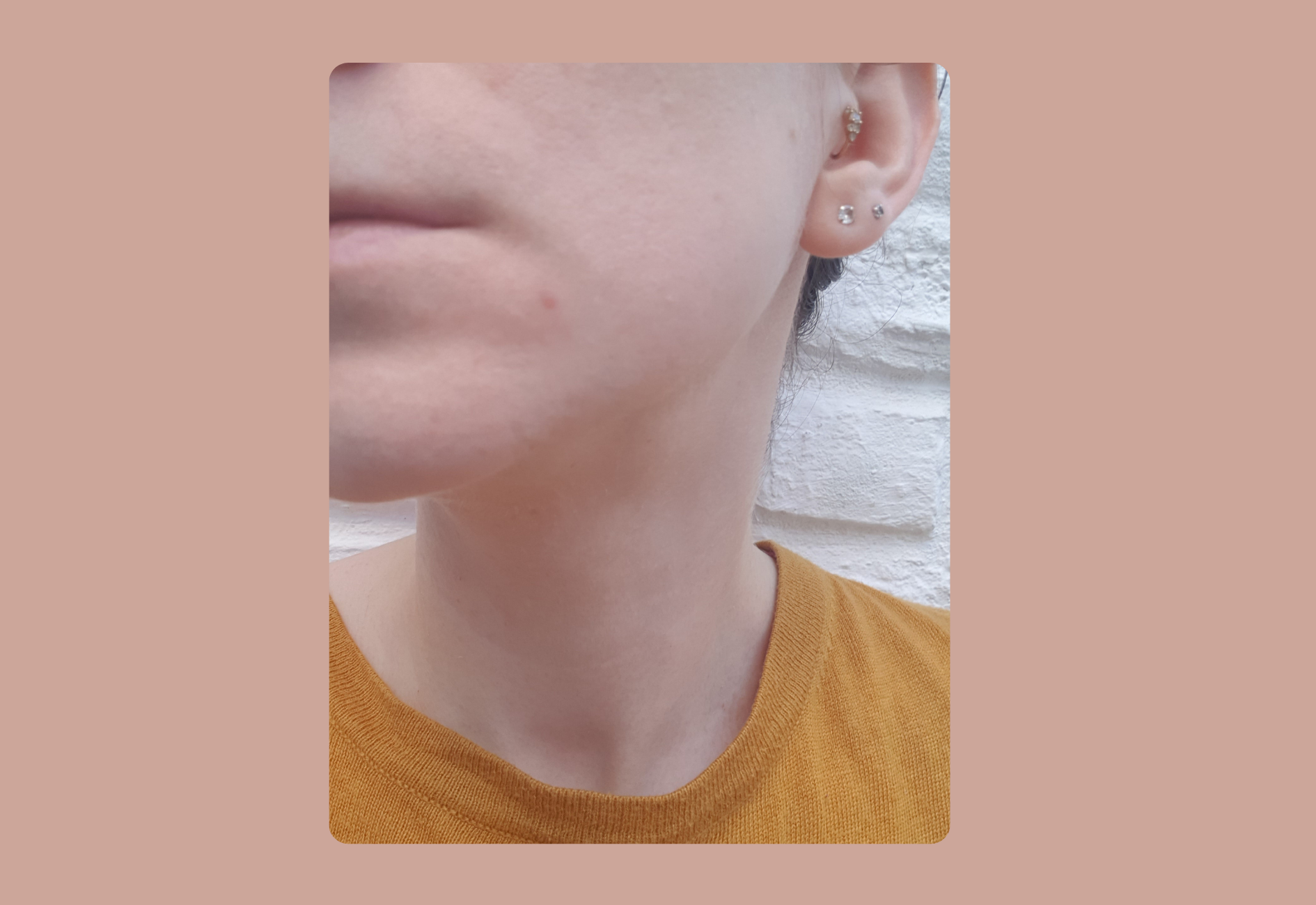 Pimple evolution after three days with SOME BY MI patch