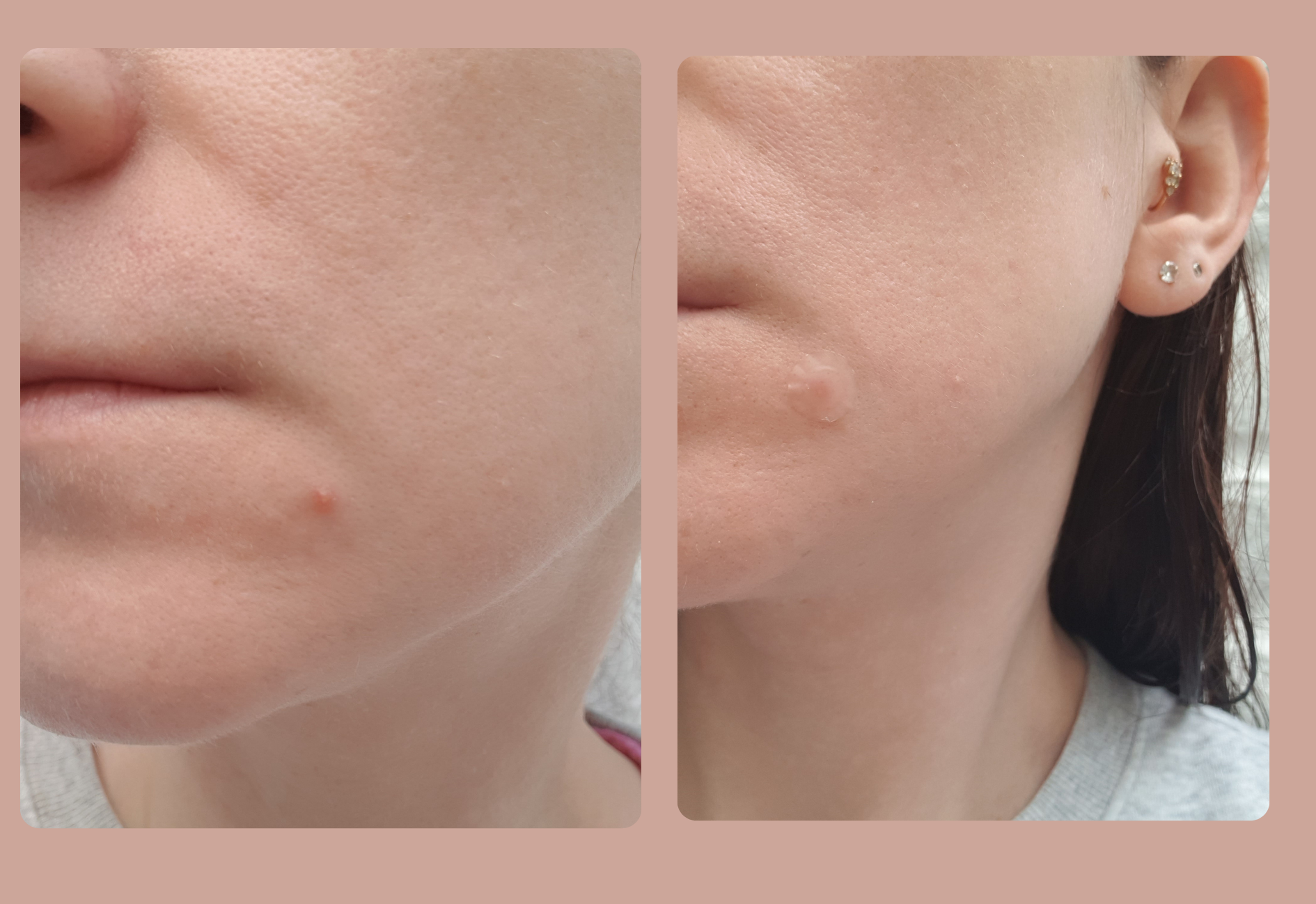 SOME BY MI Clear Spot Patch covering a pimple - before and after