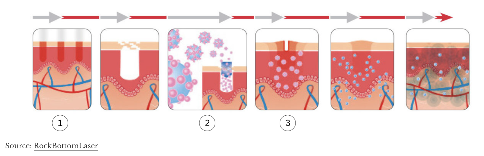 Illustration of how LaseMD works, creating microscopic channels in the skin for deep serum penetration
