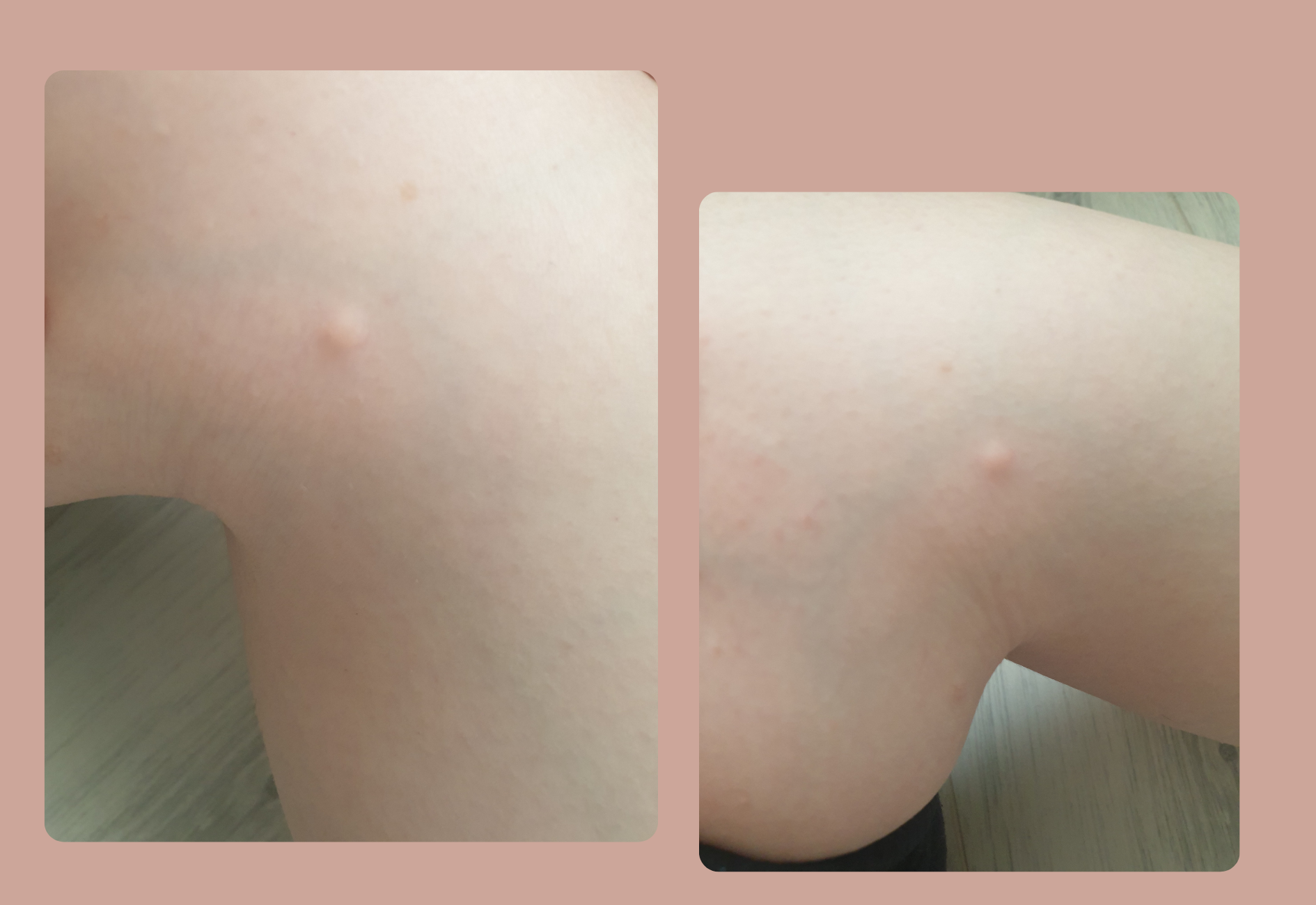 Dermatofibroma on leg from second angle