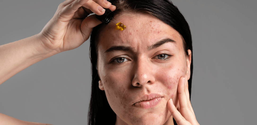 Cover-pic-Purging-After-a-Skincare-Break