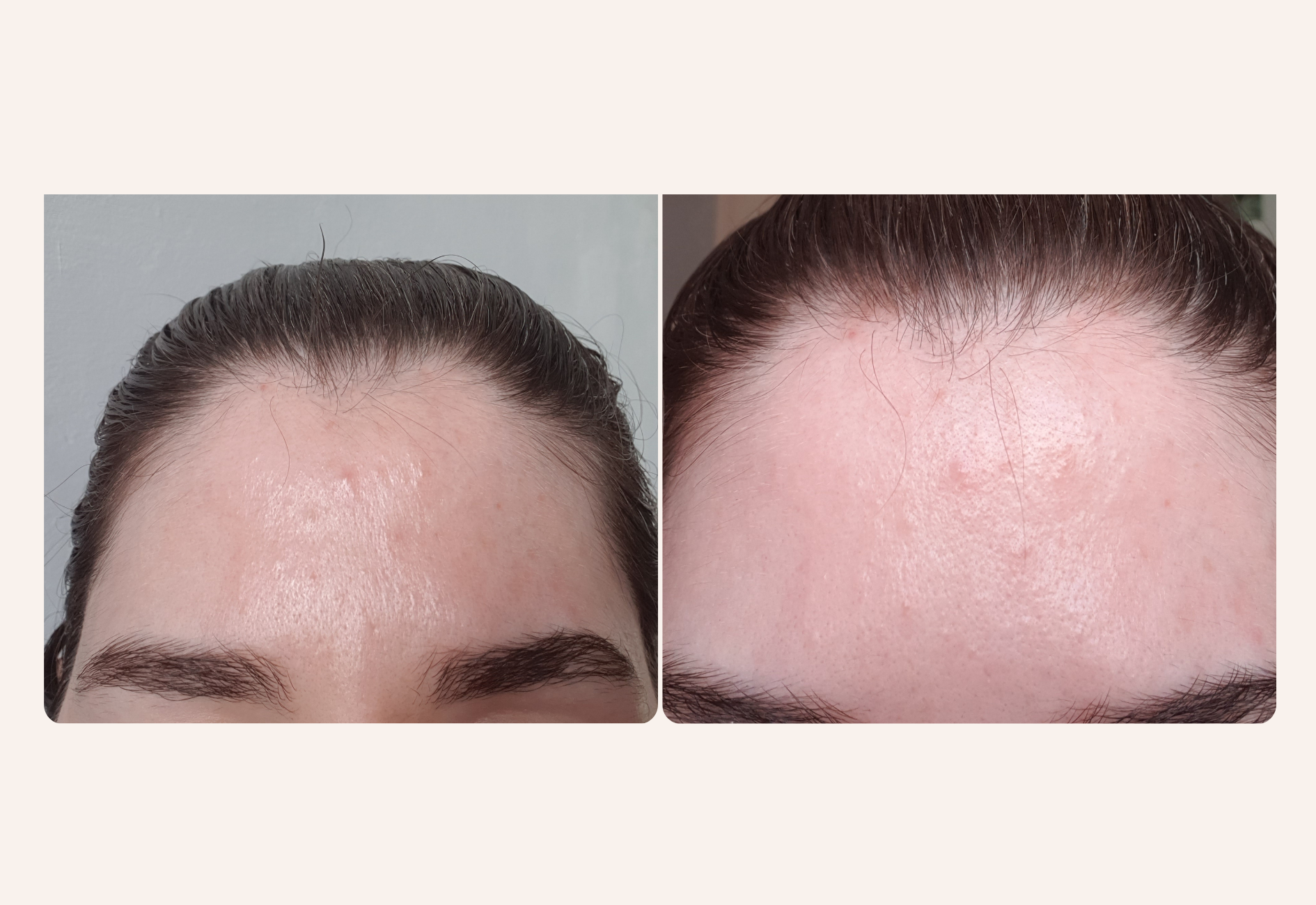 Purging after a skincare break with tretinoin and azelaic acid picture of my forehead