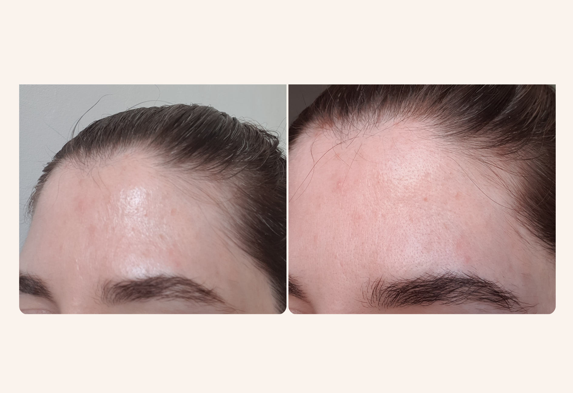 Purging after a skincare break with tretinoin and azelaic acid picture of my forehead (part 2)