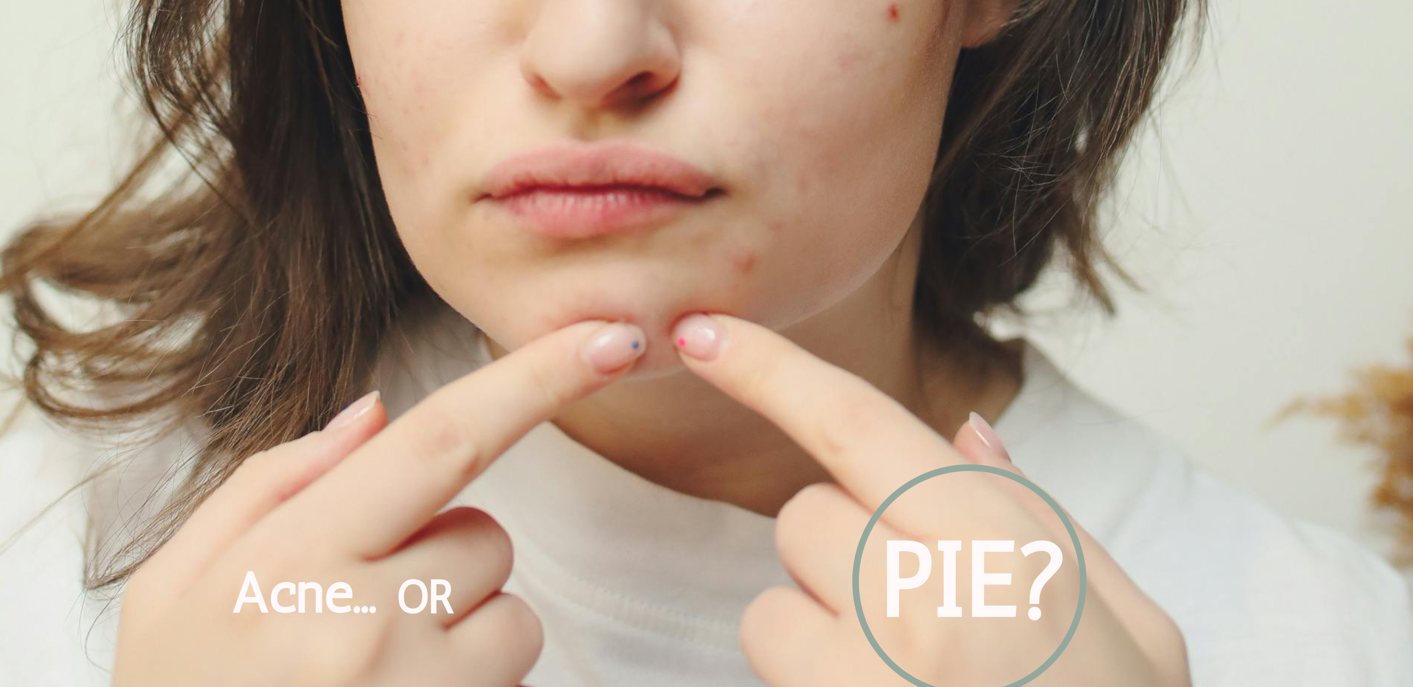 PIE: The red marks people mistake for acne – Beautifully Moi